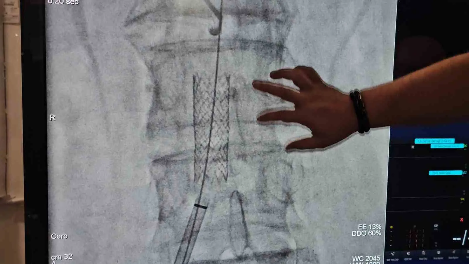 ZONGULDAK'TA YAKLAŞIK BİR YILDIR BEL, KALÇA VE BACAK AĞRILARI NEDENİYLE YÜRÜMEKTE GÜÇLÜK ÇEKEN 73 YAŞINDAKİ HASTANIN, VÜCUDUNUN ALT KISMINA KAN TAŞIYAN ANA DAMARININ TAMAMEN TIKALI OLDUĞU ORTAYA ÇIKTI. BEL FITIĞI VE DİZ RAHATSIZLIKLARINA YÖNELİK TEDAVİLERDEN SONUÇ ALAMAYAN HASTA, AMELİYATSIZ YÖNTEMLE TEDAVİ EDİLDİ.
